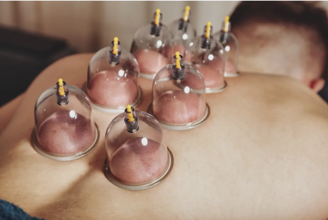 Cupping therapy on the back